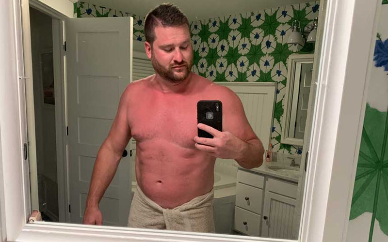 Bro Glo founder sunburned